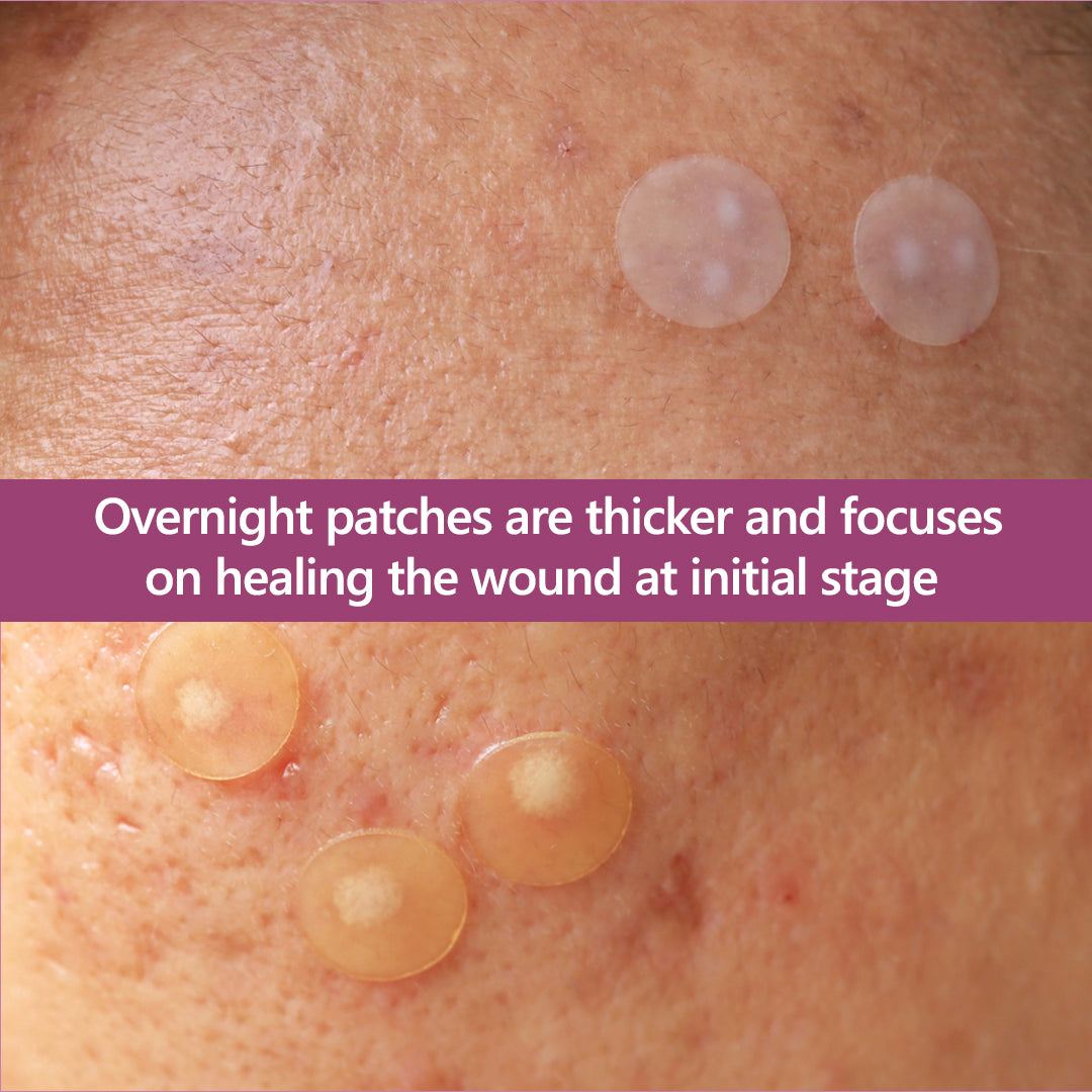 Floren Overnight Wonder Pimple Patch | Thicker Hydrocolloid Acne Patch | Effective & extra adhesion for better results | Facial stickers | Facial South Korean skin care | Drug-Free | 28ct (Pack of 1)