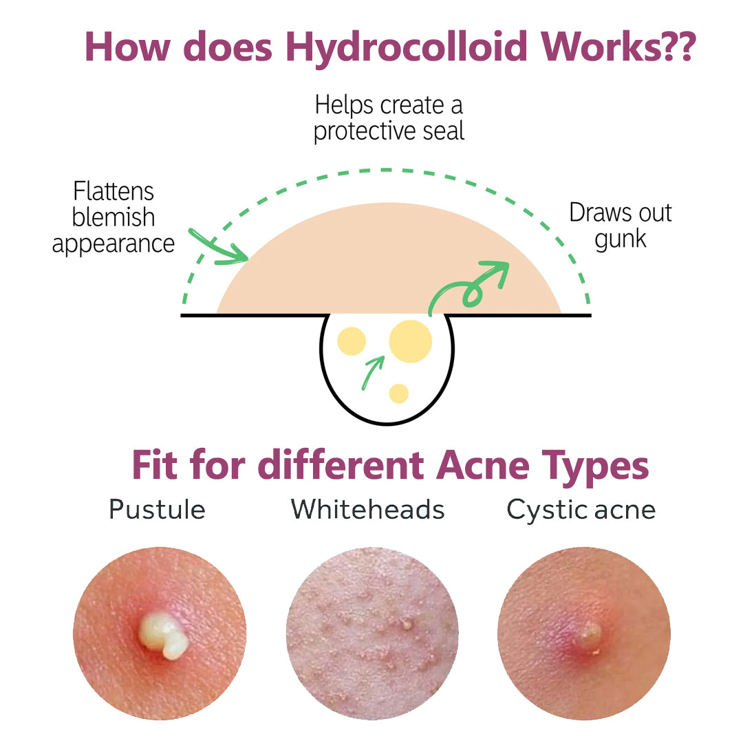 Floren Overnight Wonder Pimple Patch | Thicker Hydrocolloid Acne Patch | Effective & extra adhesion for better results | Facial stickers | Facial South Korean skin care | Drug-Free | 28ct (Pack of 1)