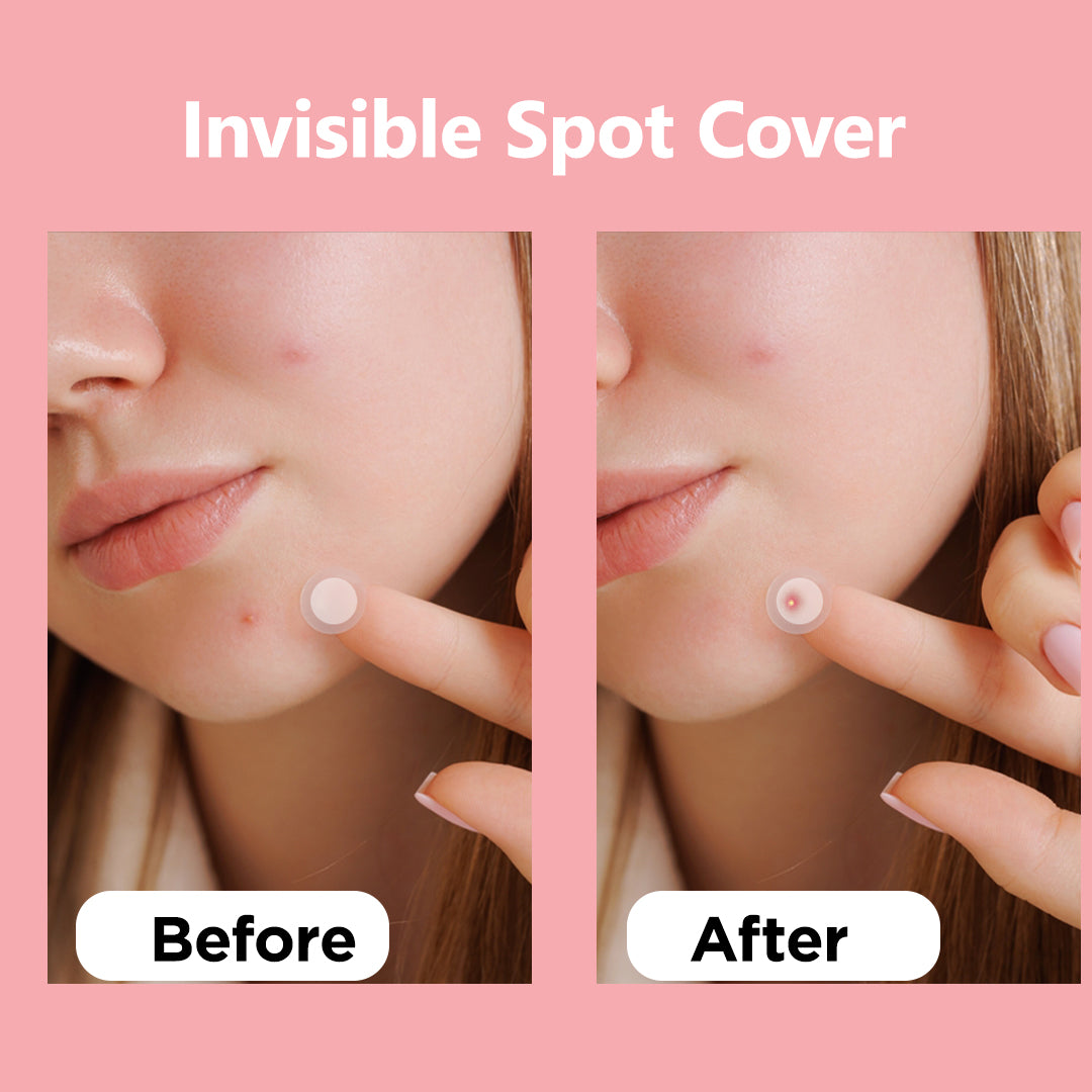 Floren Wonder Pimple Patch | Invisible Daytime Acne spot cover | Hydrocolloid Patch | For Zits, Blemishes, & Breakouts | Facial South Korean skin care | Drug-free, Gentle & Cruelty free | (30 (Pack of 1))