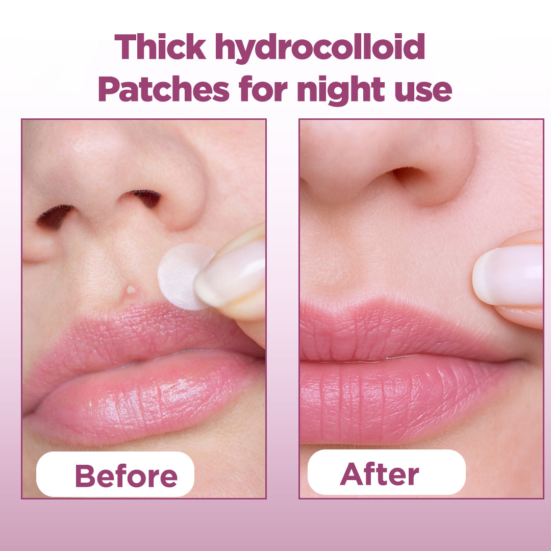 Floren Overnight Wonder Pimple Patch | Thicker Hydrocolloid Acne Patch | Effective & extra adhesion for better results | Facial stickers | Facial South Korean skin care | Drug-Free | 28ct (Pack of 1)