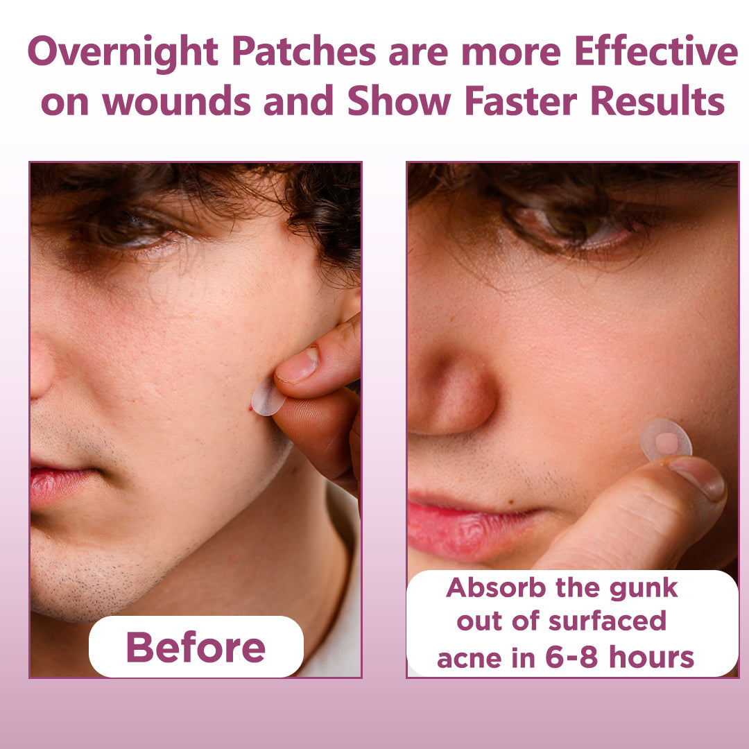 Floren Overnight Wonder Pimple Patch | Thicker Hydrocolloid Acne Patch | Effective & extra adhesion for better results | Facial stickers | Facial South Korean skin care | Drug-Free | 28ct (Pack of 1)